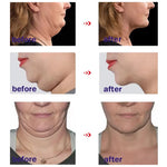 V-Shape Face Slimming Cream Removal