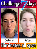 Remove Dark Spots Effective Whitening Freckles Cream