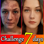 Remove Dark Spots Effective Whitening Freckles Cream