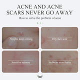 Acne Cream Acne Removal Fades Acne Marks