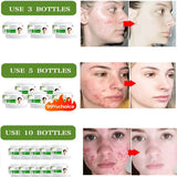 Acne Removal Cream | Acne Scar Removal Cream | Retiredgrma