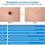 Skin Tag Remover Kit | Skin Tag Removal | Retiredgrma