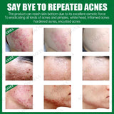 Acne Cream Herbal Extracts to Eliminate Acne and Acne Marks