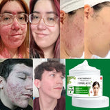 Acne Cream Herbal Extracts to Eliminate Acne and Acne Marks