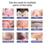  Acne Treatment Cream | Face Acne Cream | Retiredgrma