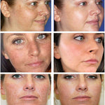 Freckle Removal Cream | Dark Spot Remover | Retiredgrma