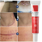 Scar Stretch Marks Remover Cream