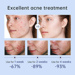  Acne Treatment Cream | Face Acne Cream | Retiredgrma