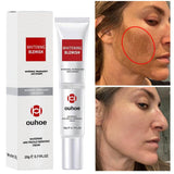 Freckle Removal Cream | Dark Spot Remover | Retiredgrma