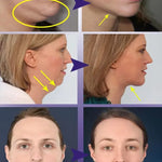 V-Shape Face Slimming Cream Removal
