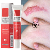 Scar Stretch Marks Remover Cream