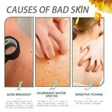 Body Acne Removal Cream Treatment Face Butt Back Acne Marks Smooth Repair Chicken Skin Cream