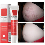 Scar Stretch Marks Remover Cream