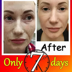 Remove Dark Spots Effective Whitening Freckles Cream
