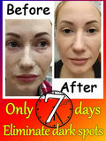 Remove Dark Spots Effective Whitening Freckles Cream