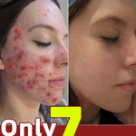 Acne Cream Herbal Extracts to Eliminate Acne and Acne Marks