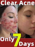 Acne Cream Herbal Extracts to Eliminate Acne and Acne Marks