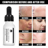 Niacinamide Dark Spots Remover Serum Freckle