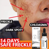 Niacinamide Dark Spots Remover Serum Freckle