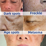 Dark Spot Remover For Face Removal Cream