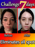 Remove Dark Spots Effective Whitening Freckles Cream