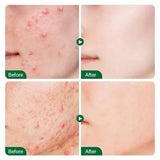 Tea Tree Acne Removal Serum Anti-Acne Gel