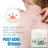 Body Acne Removal Cream Treatment Face Butt Back Acne Marks Smooth Repair Chicken Skin Cream