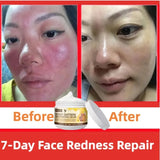 Anti Red Nose Acne Blackhead Pimples Shrink Pores Anti-aging Clearer Skin