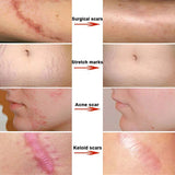 Scar Stretch Marks Remover Cream