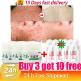 Body Acne Removal Cream Treatment Face Butt Back Acne Marks Smooth Repair Chicken Skin Cream