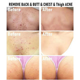Body Acne Removal Cream Treatment Face Butt Back Acne Marks Smooth Repair Chicken Skin Cream