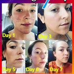 Remove Dark Spots Effective Whitening Freckles Cream