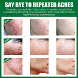 Acne Removal Cream | Acne Scar Removal Cream | Retiredgrma