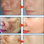 Dark Spot Remover For Face Removal Cream