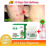 Body Acne Removal Cream Treatment Face Butt Back Acne Marks Smooth Repair Chicken Skin Cream
