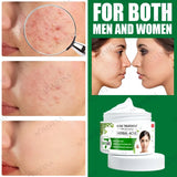 Acne Cream Herbal Extracts to Eliminate Acne and Acne Marks