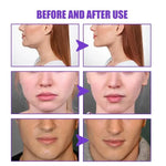 V-Shape Removal Masseter Muscle Double Chin