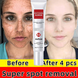 Freckle Removal Cream | Dark Spot Remover | Retiredgrma