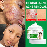 Acne Removal Cream | Acne Scar Removal Cream | Retiredgrma